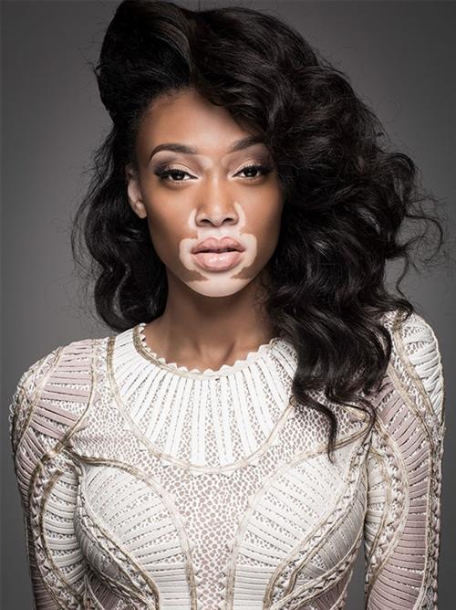 Winnie Harlow